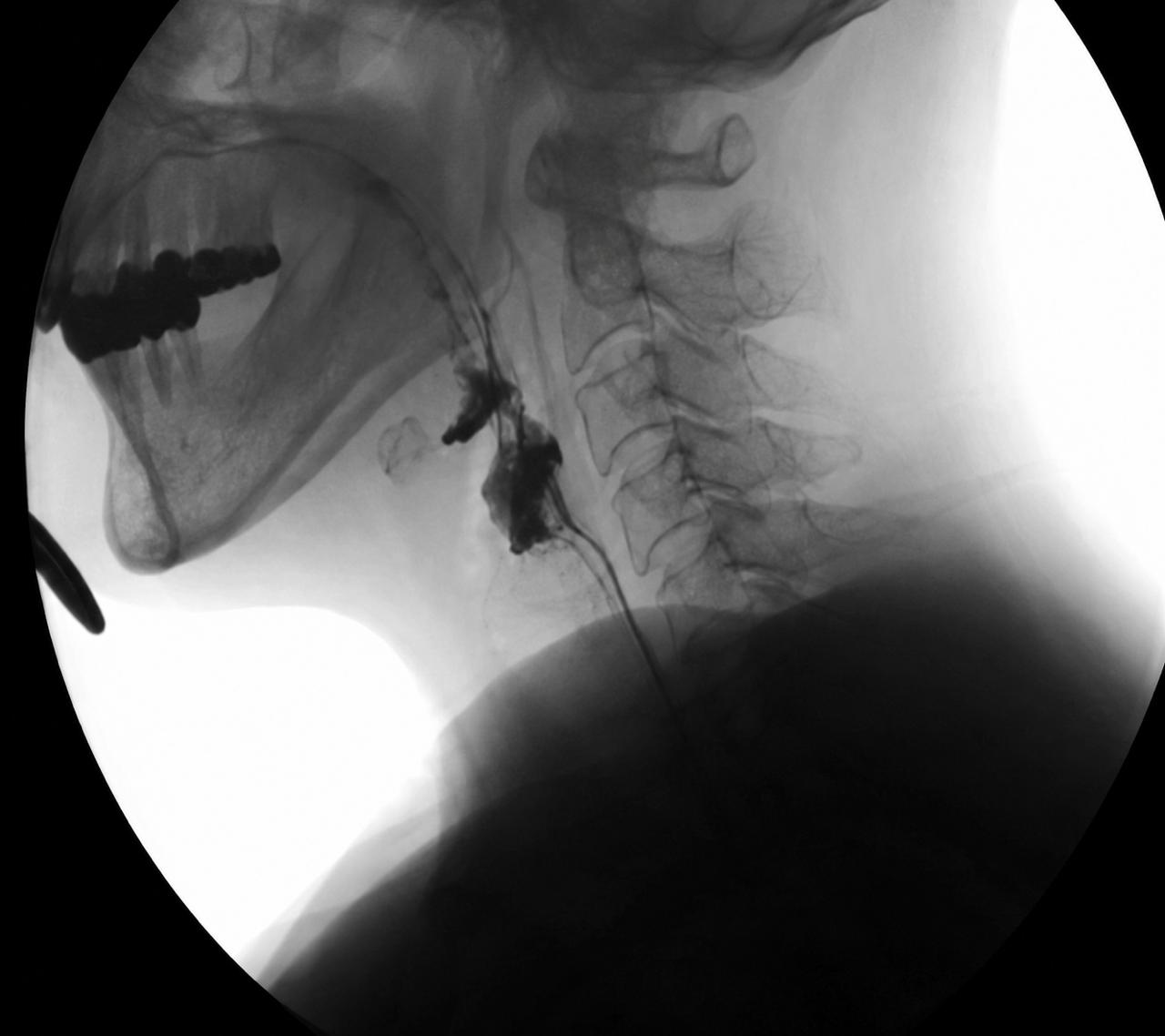 Lateral VFSS swallow imaging